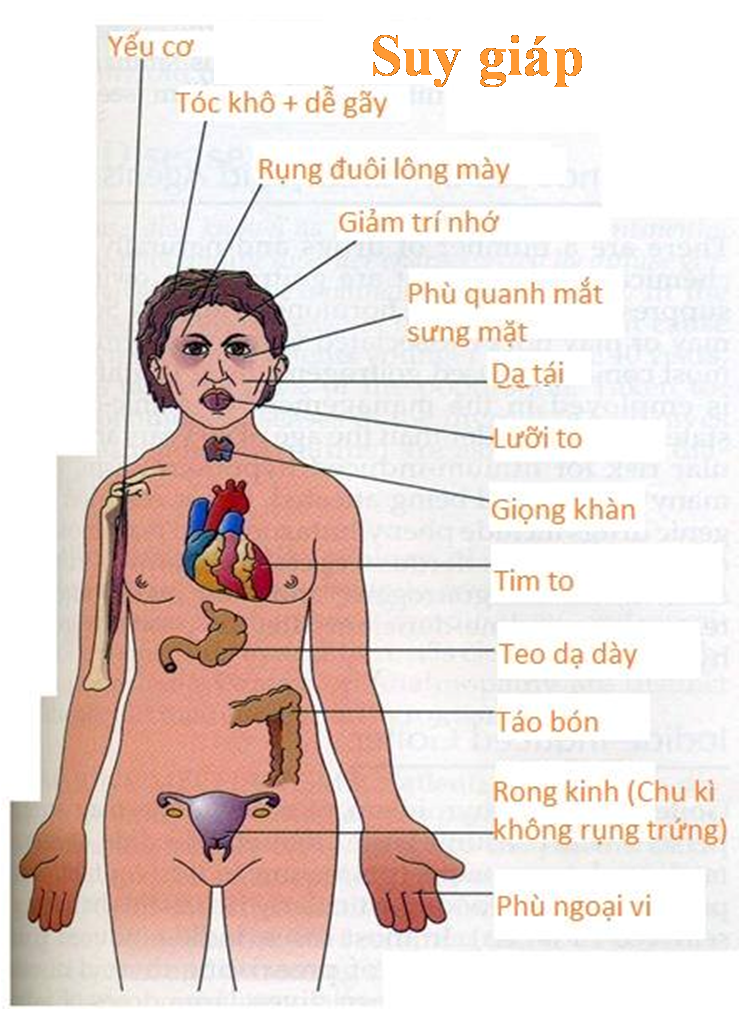 Hôn mê do suy giáp - Hình ảnh minh họa